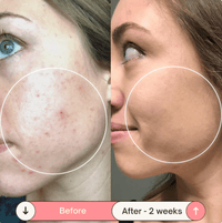 High Frequency Skin Therapy Wand - NoveltyExpress