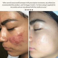 High Frequency Skin Therapy Wand - NoveltyExpress