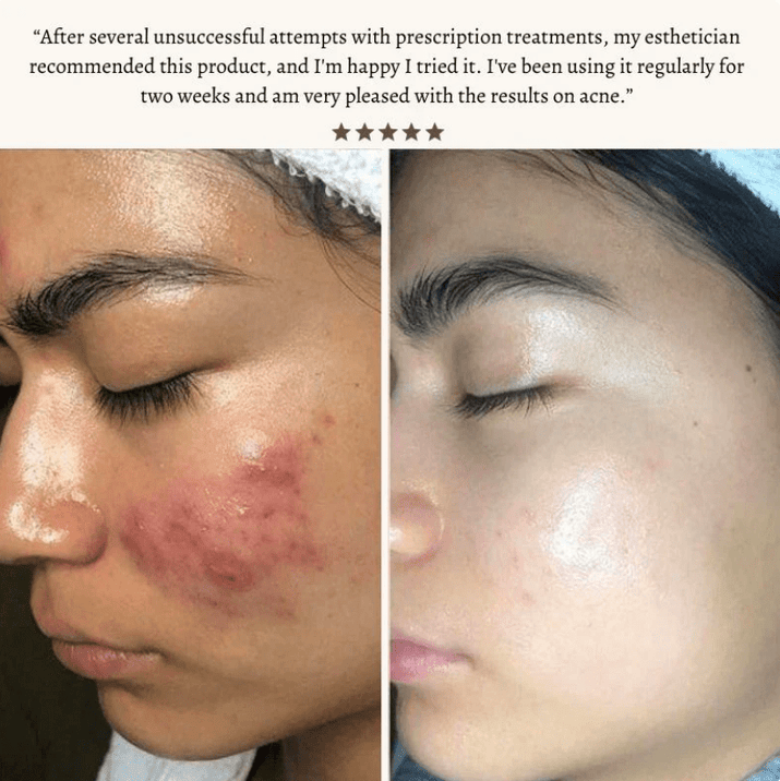 High Frequency Skin Therapy Wand - NoveltyExpress